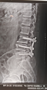 LCS L3-4-5, Deg Scoli,revision Sx, Fixation L3-5, TLIF L3-4 - Pune ...